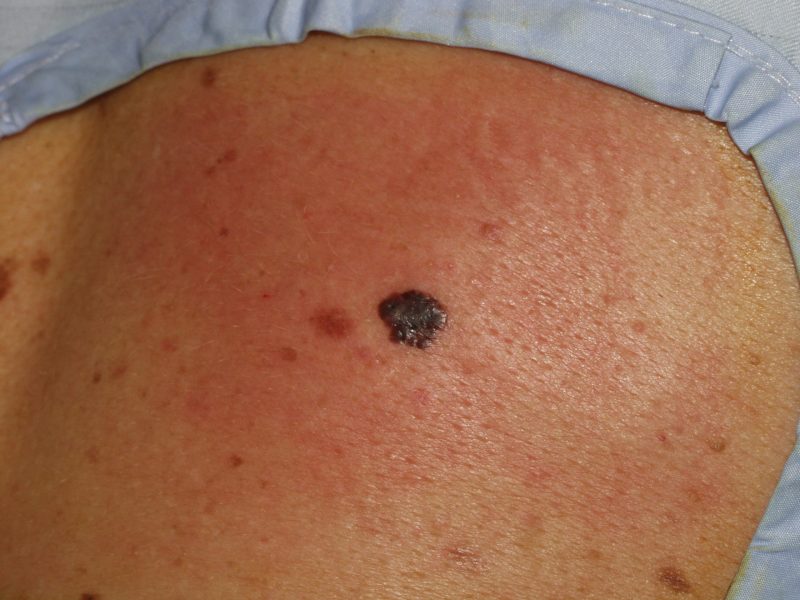 Immagini Melanoma e Tumori della Pelle in Diversi Stadi