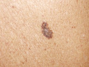 Melanoma tumori delle cute