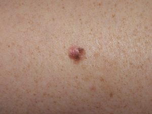 Melanoma tumori della pelle