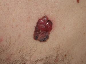 melanoma dr. Testori