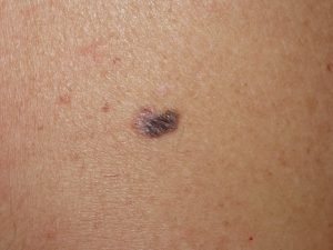 melanoma dr. Alessandro Testori