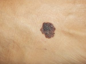 melanoma asintomatico