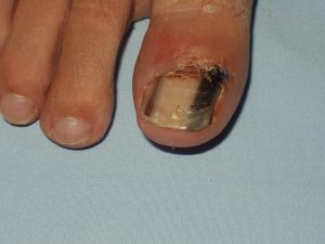 melanoma matrice ungueale alluce