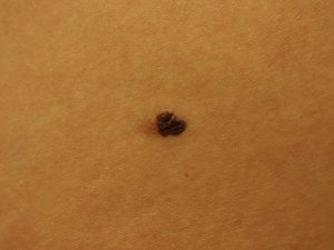 melanoma su nevo
