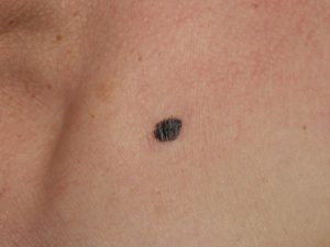 melanoma neo