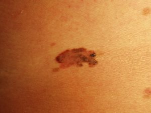 melanoma superficiale
