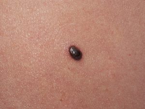 melanoma prevenzione