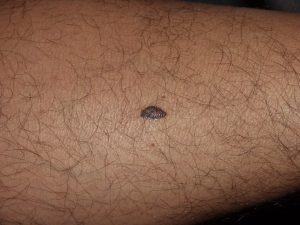 melanoma consulto MIlano