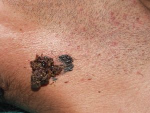 Melanoma nei pelle