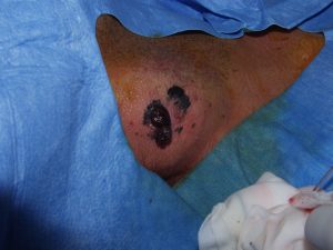 Melanoma pelle Testori