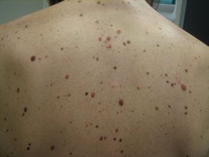 Melanoma nevi atipici multipli