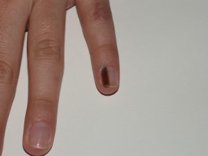 Melanoma nevo unghia